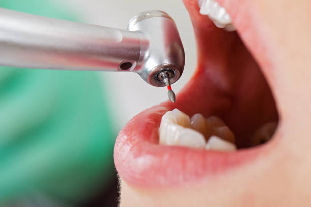 Best Emergency Wisdom Teeth Removal in North Fork, AZ